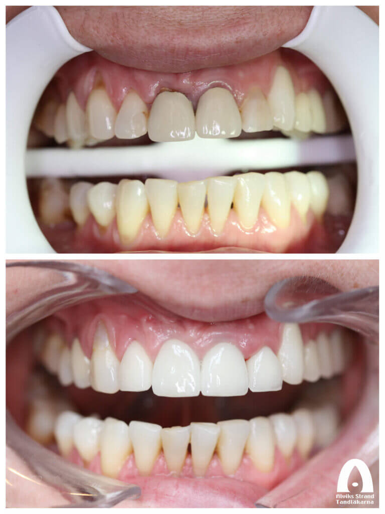 Estetisk tandvård - Fyra framtänder