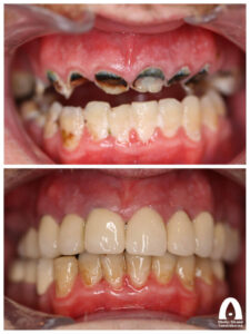 Uppbyggnad av skadade tänder med kronor